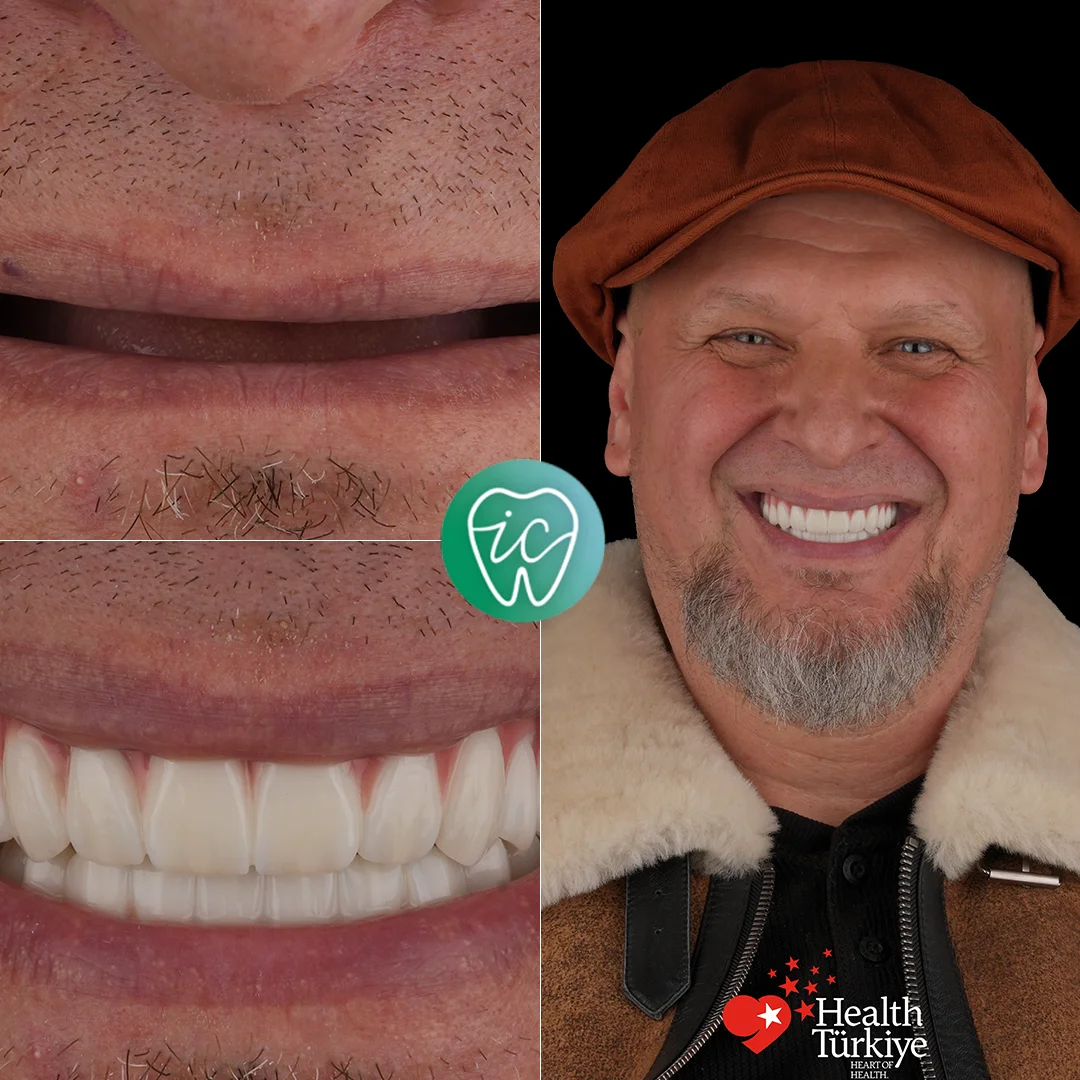 Treatment before and after